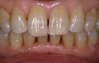 歯のホワイトニング・施術前