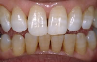 歯のホワイトニング・施術後
