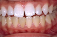歯のホワイトニング・施術後